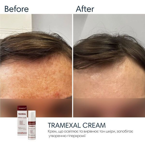 Braderm Tramexal Cream освітлюючий крем 00-00000388 фото